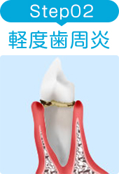 STEP2 軽度歯周炎