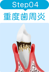 STEP4 重度歯周炎